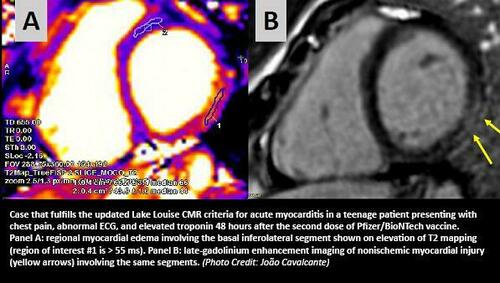 MyocarditismRNAvaccine text